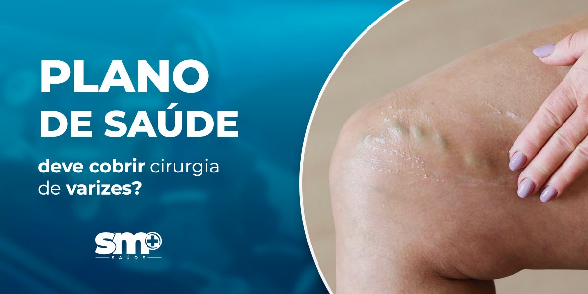 Plano de saúde deve cobrir cirurgia de varizes